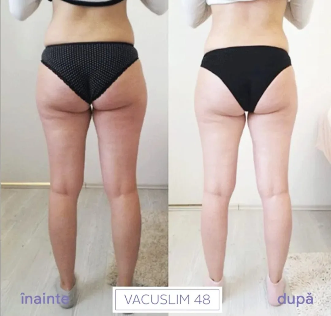 Rezultat înainte și după tratamentul Vacuslim 48 – exemplul 1
