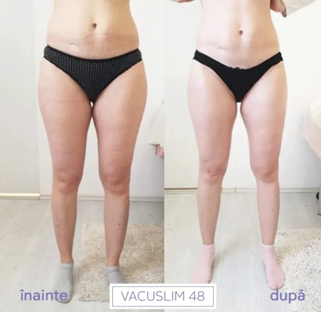 Rezultat înainte și după tratamentul Vacuslim 48 – exemplul 2